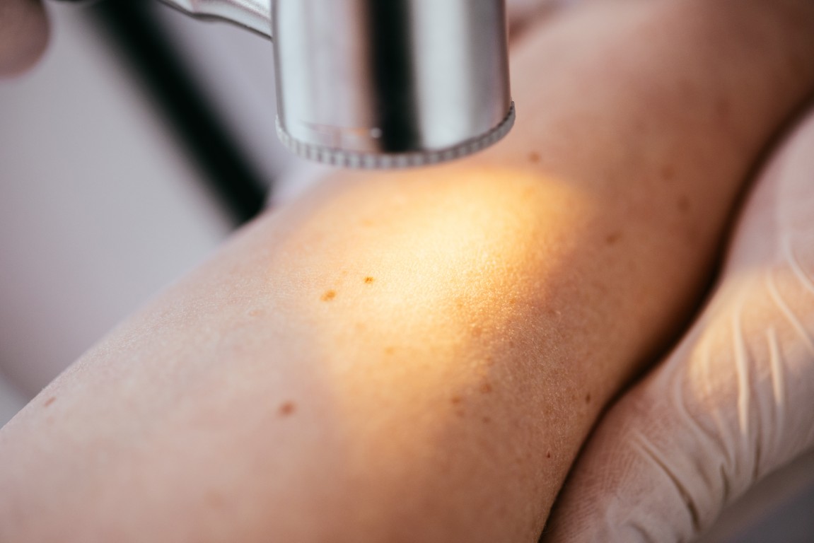 badanie znamienia dermatoskopem profilaktyka raka skory